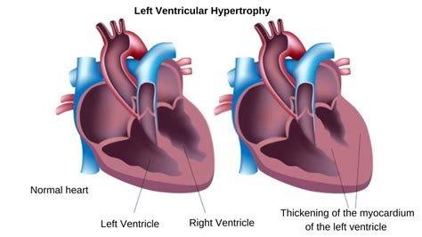 left ventricular hypertrophy leg pain